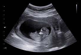 Pregnancy Ultrasound